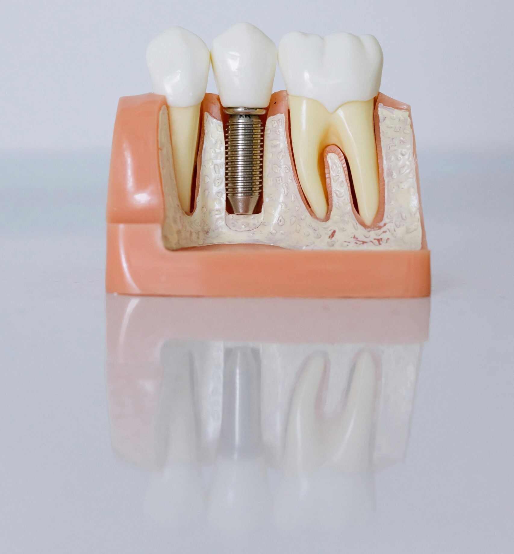 Cracked Tooth Syndrome (CTS)